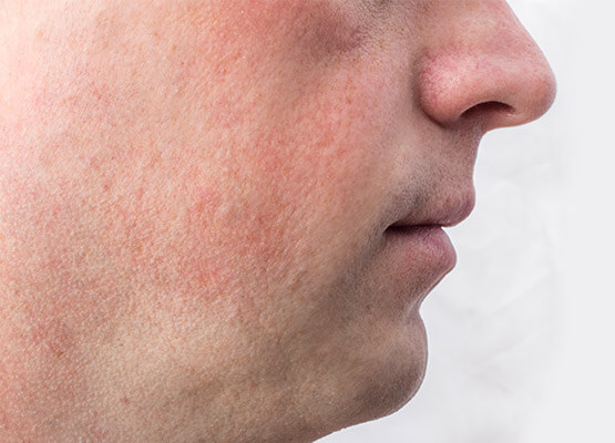 beard transplant uk