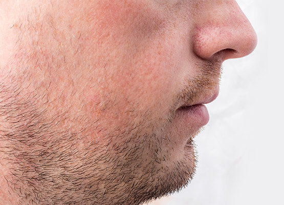 beard transplant before and after