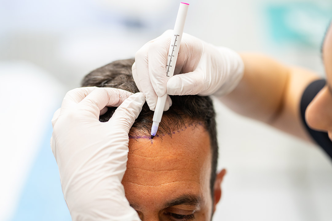 hair implants price