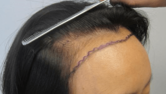 Female hair transplant before and after