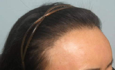 13-Female hair transplant before and after