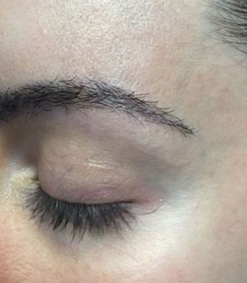 eyebrow-transplant-restoration -