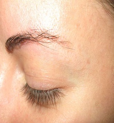 eyebrow-transplant-restoration