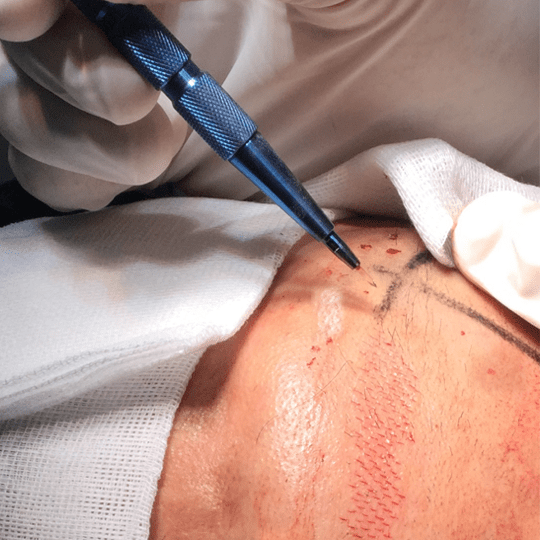 Hair Transplant Surgery