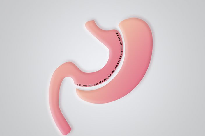 gastric sleeve surgery
