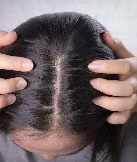 hair loss women
