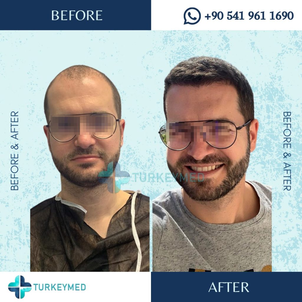 hair transplant results after 2 months