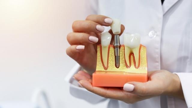 How is a Dental implant done?