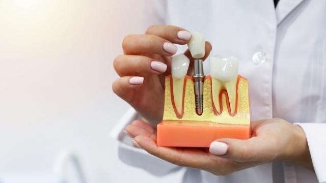 Dental Implants Surgery How is a Dental implant done?
