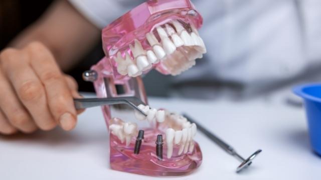 4 Types of Dental Implant