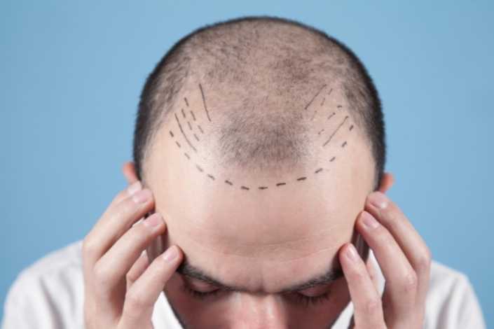 Hair Transplant Surgery