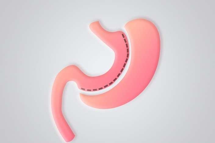 Gastric Sleeve Surgery in Turkey
