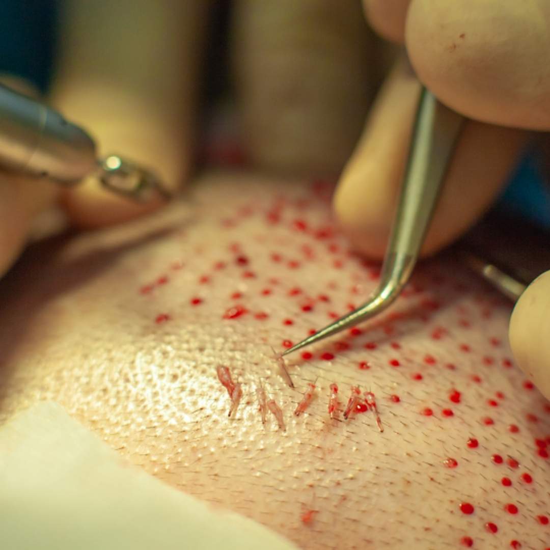 Turkeymed - Hair Transplant in Turkey
