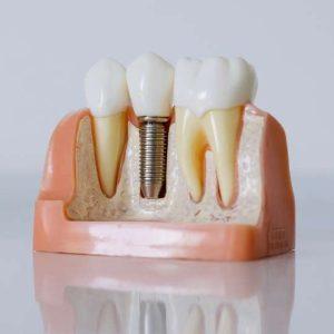 How much does it cost for a dental implant in Turkey?​