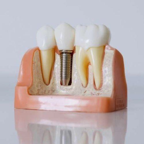 Dental implant in Turkey DentalimplantCost Turkeymed