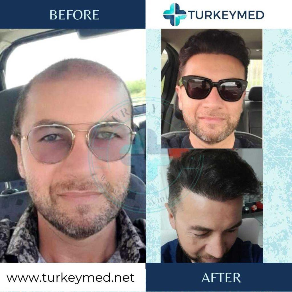hair transplant in Turkey - Turkeymed