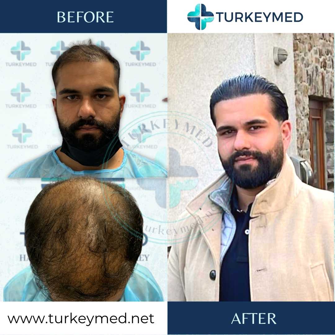 Dr Steven Gabel Hair transplant procedure before and after result photos  with 2084 grafts