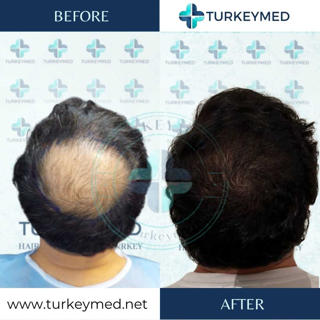 نتائج زراعة الشعر - Turkeymed