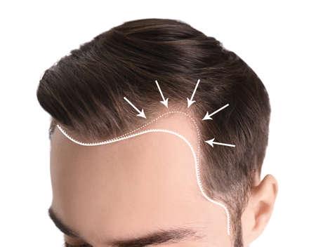 Front Hairline Design For Hair Transplant