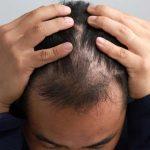DHI hair Transplant