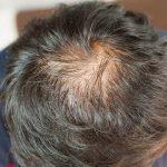 DHI hair Transplant
