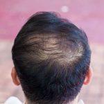 DHI hair Transplant