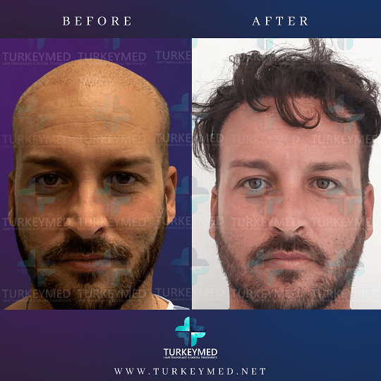 Hair Transplant Cost in Turkey - Turkeymed Hair Clinic Hair Transplant Cost in Turkey - Turkeymed Hair Clinic