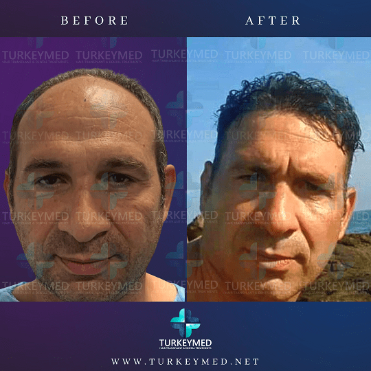 Hair Transplant Cost in Turkey - Turkeymed Hair Clinic Hair Transplant Cost in Turkey - Turkeymed Hair Clinic