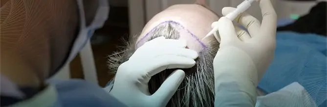 Hair Transplant Surgery