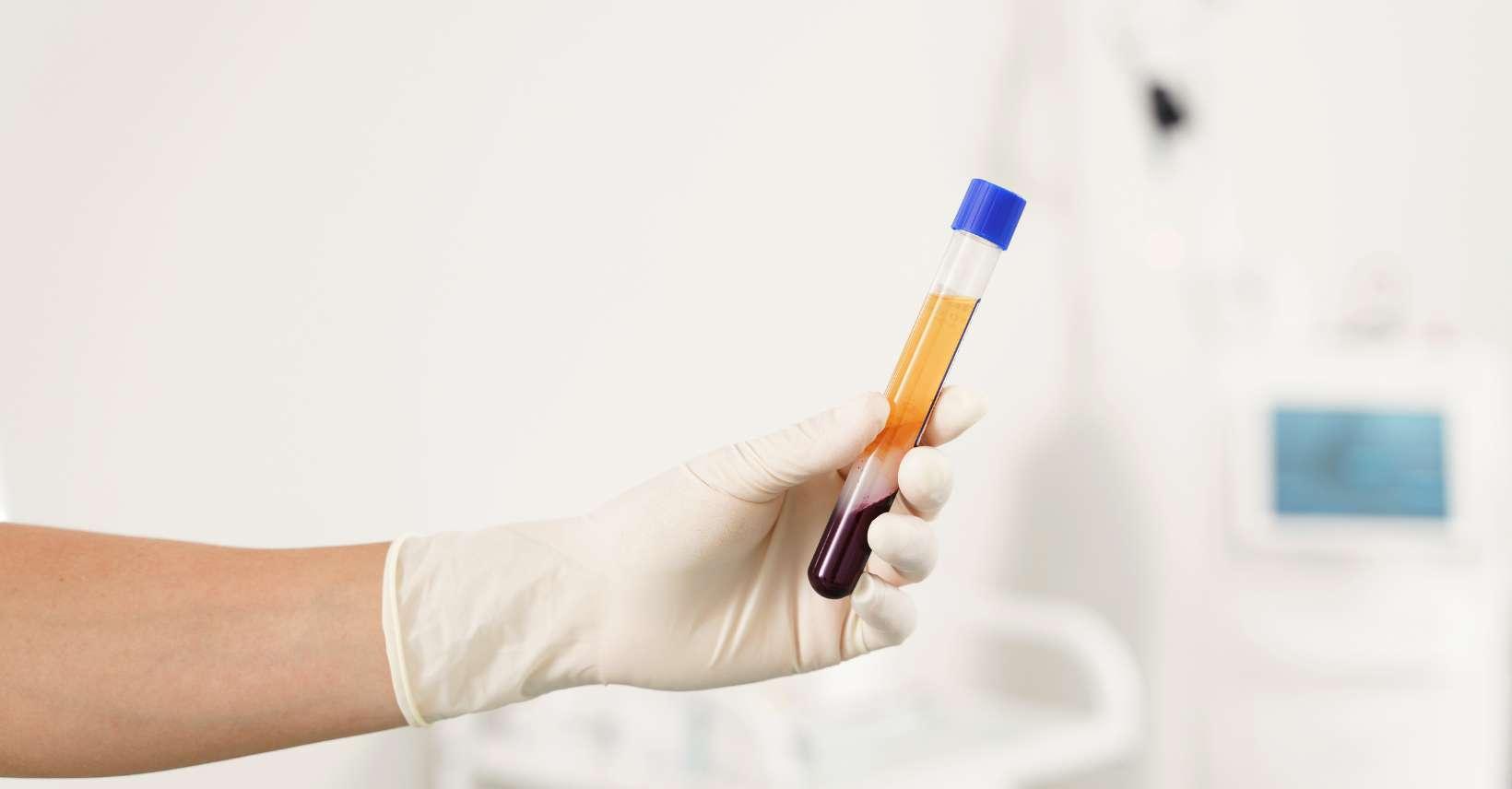Plasma rico en plaquetas (PRP)