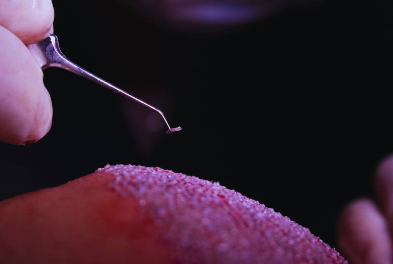 FUE Hair Transplant تقنية الاقتطاف - زراعة الشعر