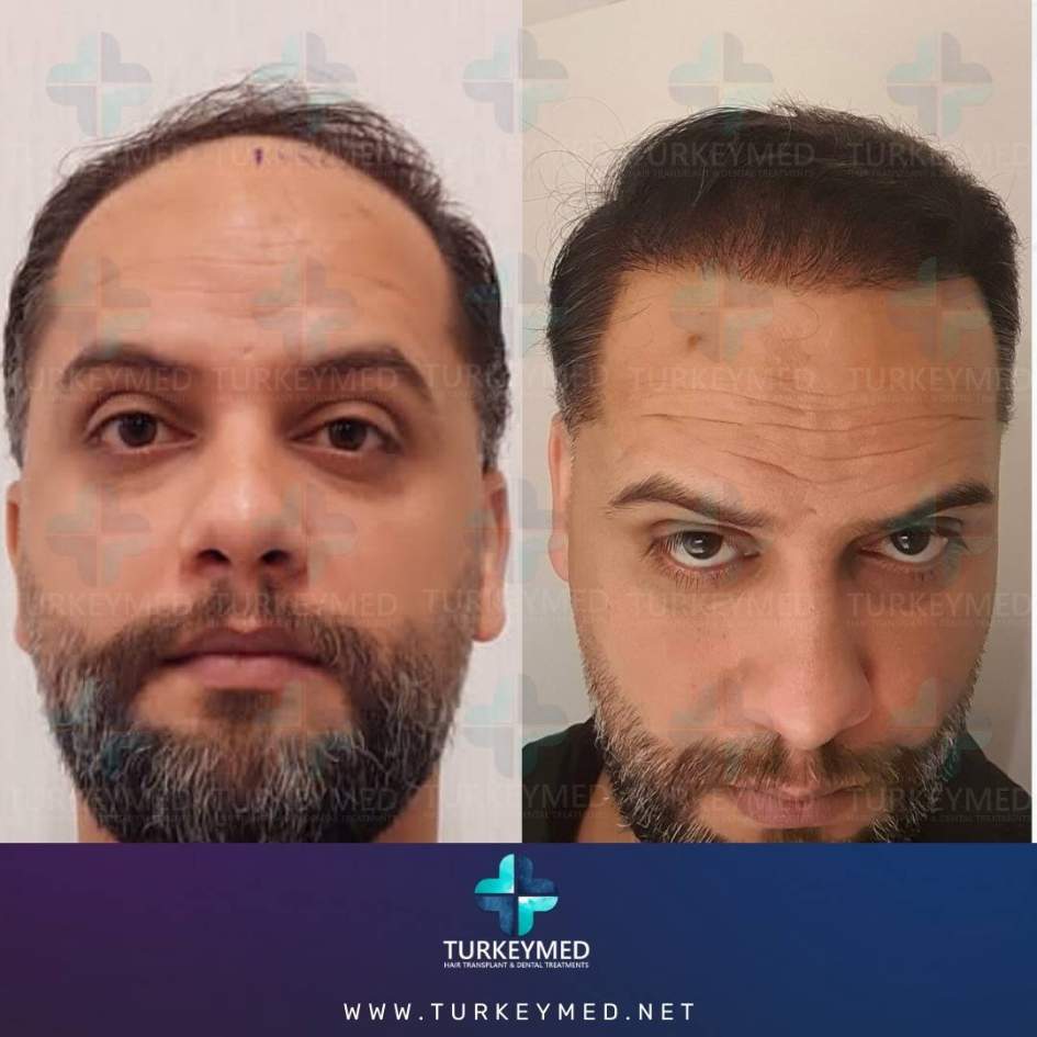 Before-and-after-hair-transplant-1.jpg