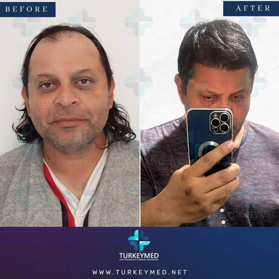 Before-and-after-hair-transplant-2.jpg