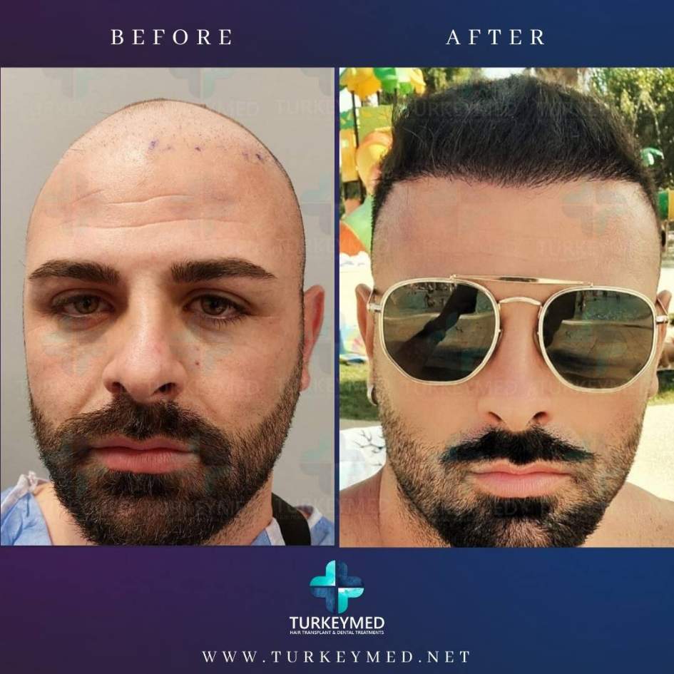 Before-and-after-hair-transplant-3.jpg