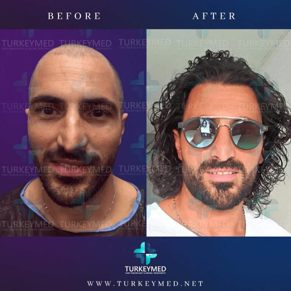 Before-and-after-hair-transplant-4.jpg