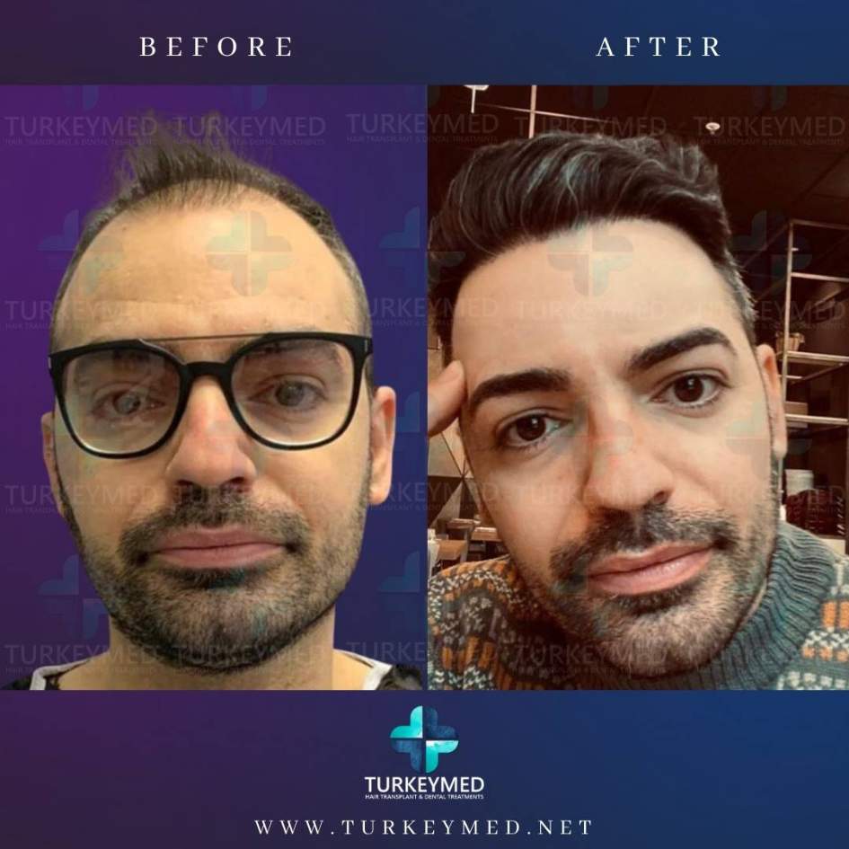 Before-and-after-hair-transplant-5.jpg