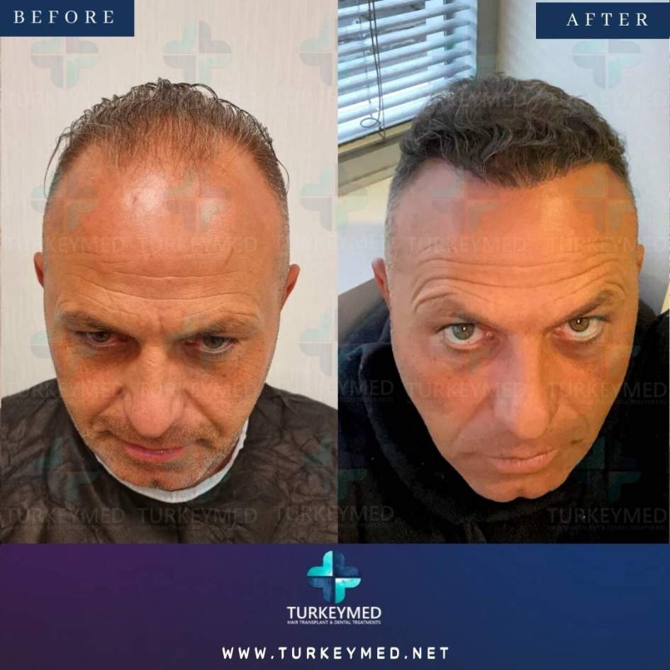 Before-and-after-hair-transplant.jpg