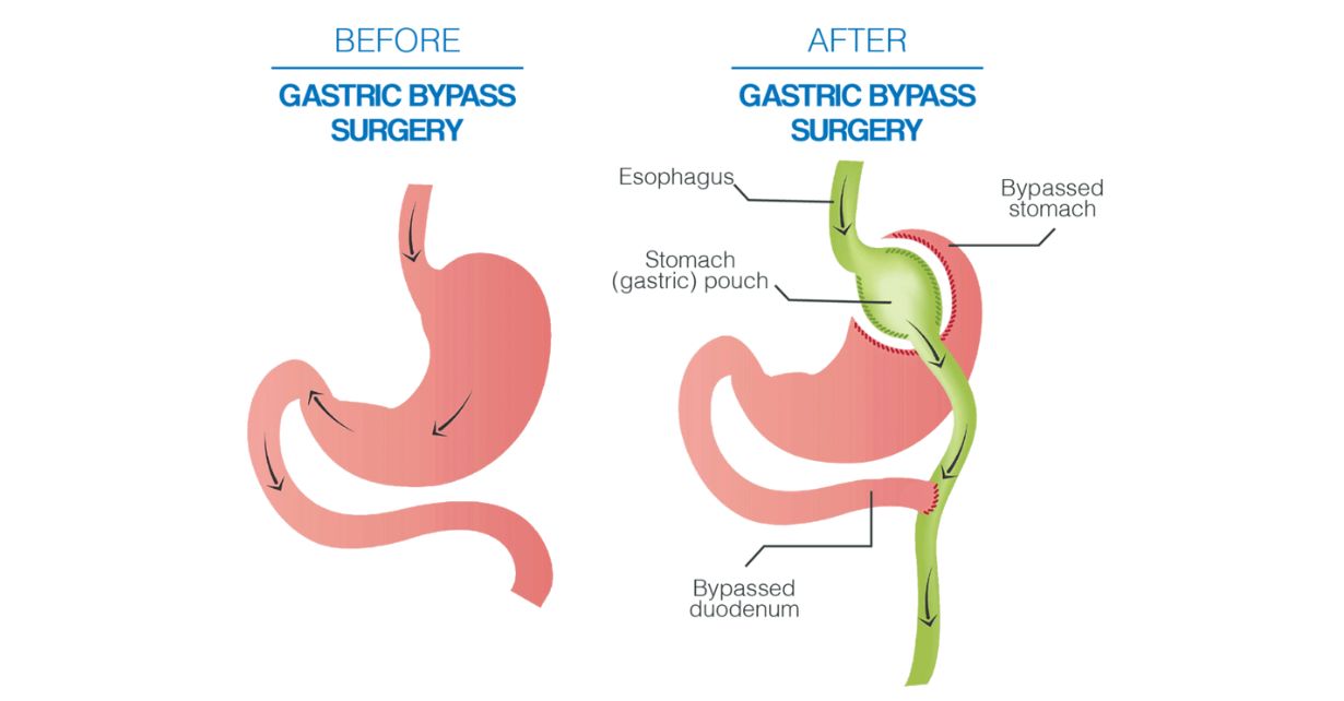 Gastric Bypass Surgery