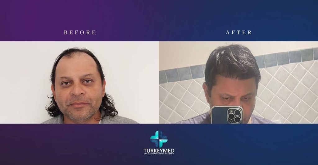 Sapphire FUE Hair Transplant