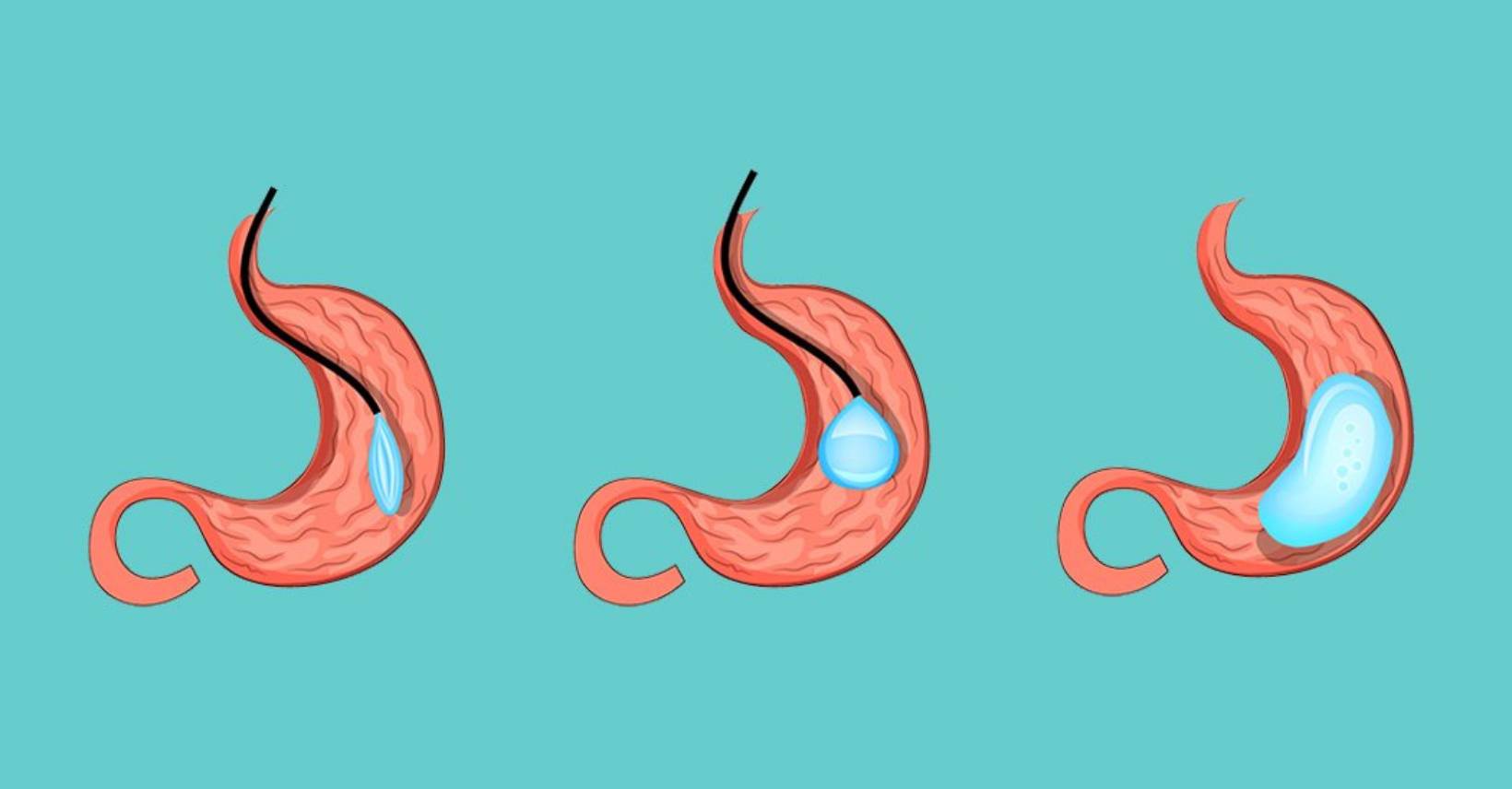 Intragastric Balloon Placement