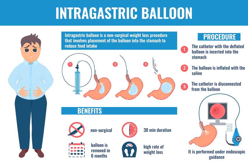 Intragastric Balloon Placement