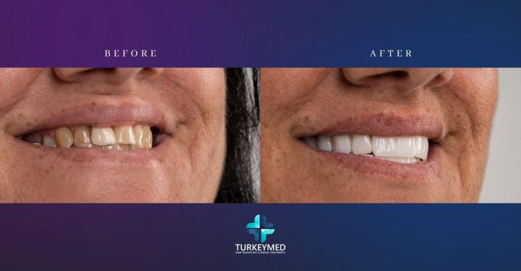 Laminate Veneers
