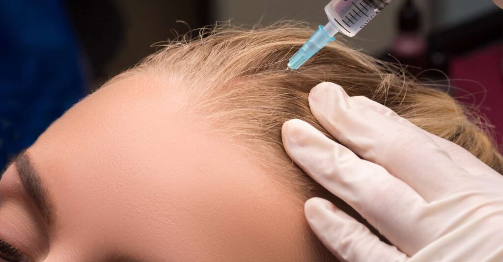 Mesotherapy Hair Loss Treatment