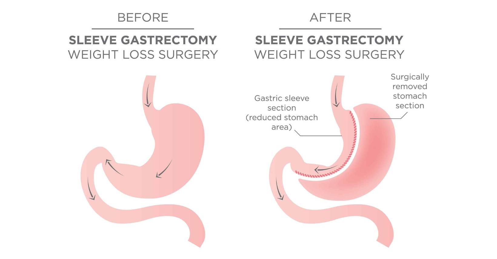 Gastric Sleeve Surgery