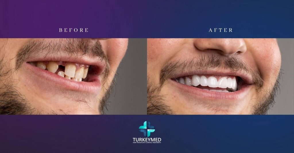Zirconium Crowns zirconium crowns in Turkeymed