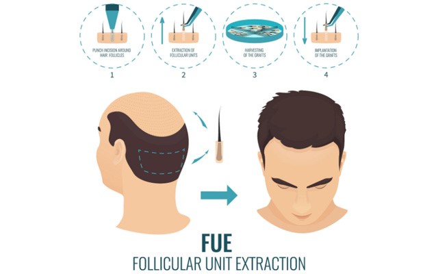 Hair Transplant Surgery تقنية الاقتطاف - زراعة الشعر