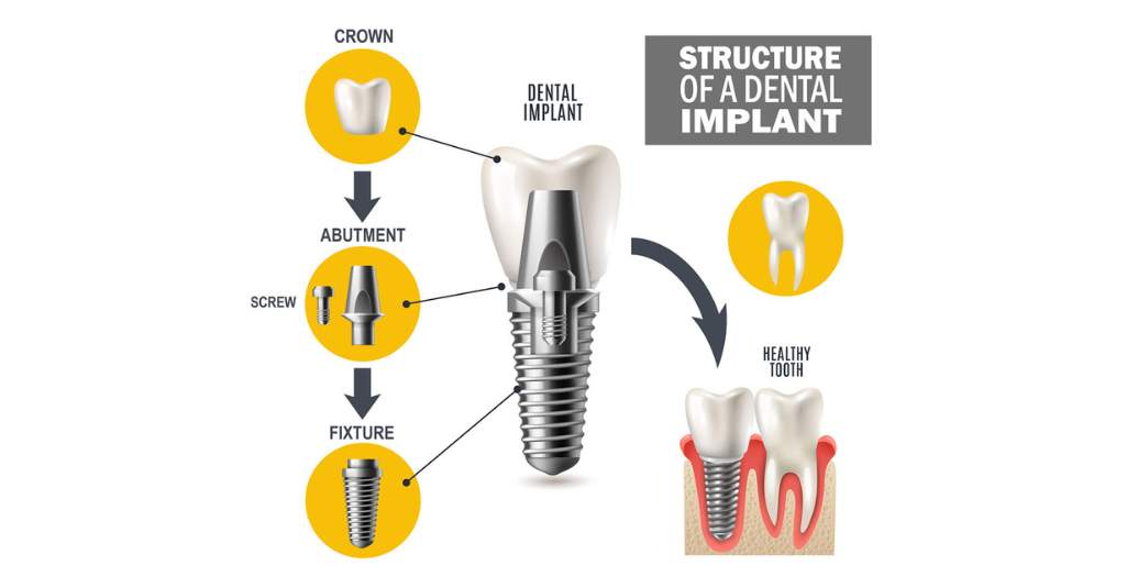 Dental implant in Turkey Dental implant in Turkey
