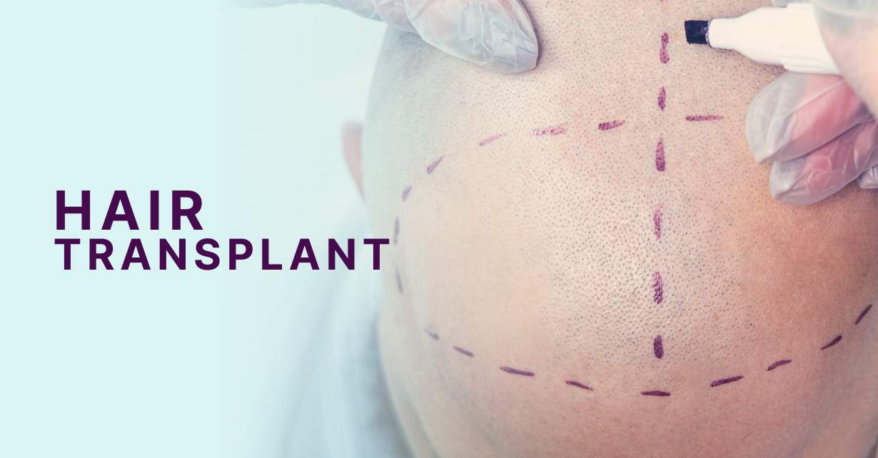 does hair transplant work