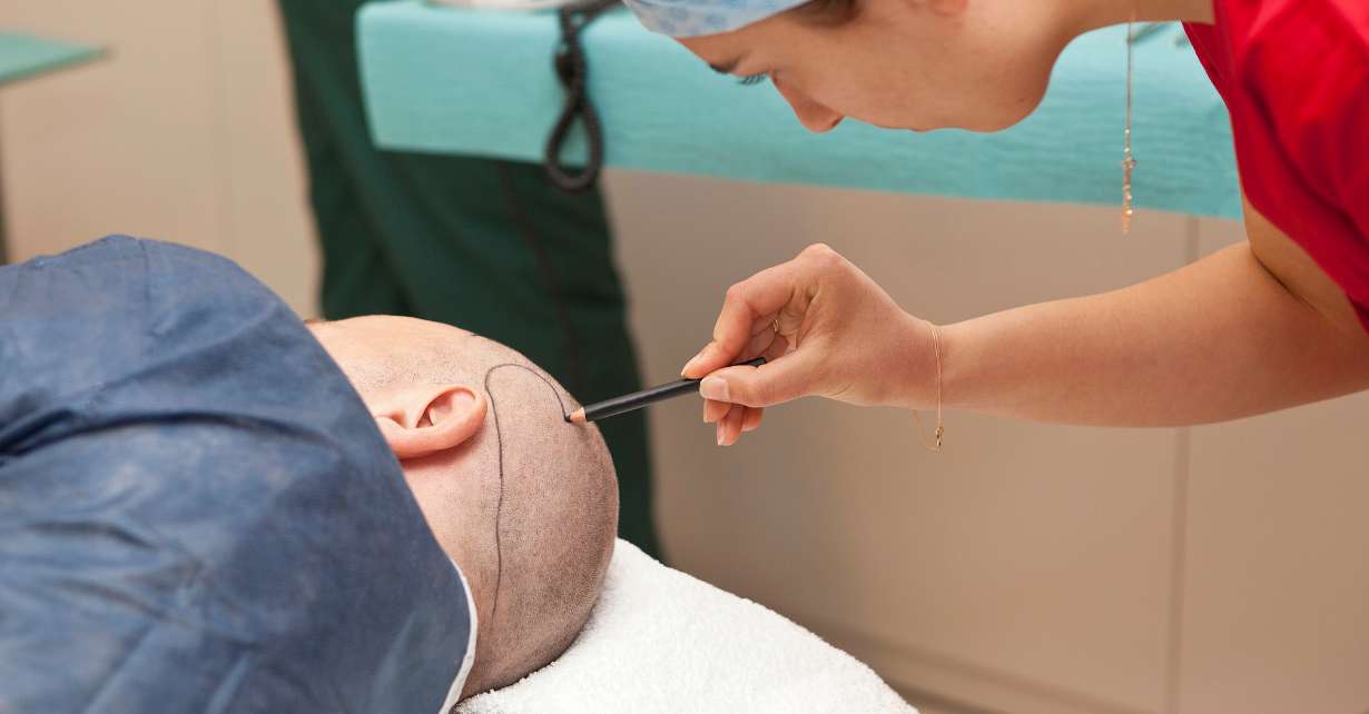 hair transplant cost hair transplant cost