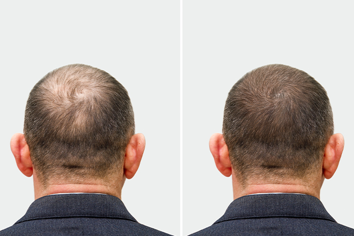 hair transfer